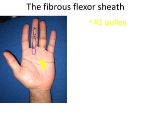 The fibrous flexor sheath
• A1 pulley
 