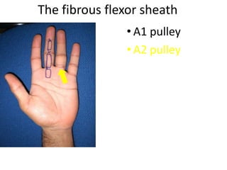 The fibrous flexor sheath
• A1 pulley
• A2 pulley
 