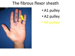 The fibrous flexor sheath
• A1 pulley
• A2 pulley
• A4 pulley
 