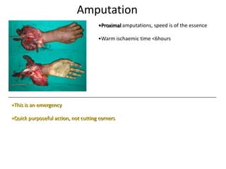 Amputation
•Proximal amputations, speed is of the essence
•Warm ischaemic time <6hours
•This is an emergency
•Quick purposeful action, not cutting corners
 