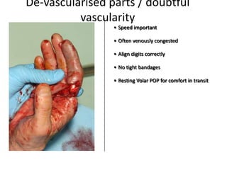 De-vascularised parts / doubtful
vascularity
• Speed important
• Often venously congested
• Align digits correctly
• No tight bandages
• Resting Volar POP for comfort in transit
 