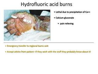 Hydrofluoric acid burns
• Lethal due to precipitation of Ca++
• Calcium gluconate
• pain relieving
• Emergency transfer to regional burns unit
• Accept advice from patient –if they work with the stuff they probably know about it!
 