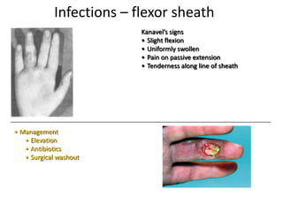 Infections – flexor sheath
Kanavel’s signs
• Slight flexion
• Uniformly swollen
• Pain on passive extension
• Tenderness along line of sheath
• Management
• Elevation
• Antibiotics
• Surgical washout
 