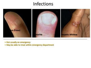 Infections
Pulp-space (Felon)
Paronychia
• Not usually an emergency
• May be able to treat within emergency department
Herpetic Whitlow
 