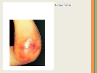 hemoarthrosis
