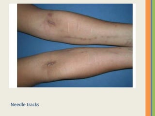 Needle tracks