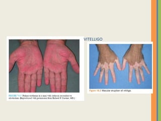 PULM ERYTH VITELLIGO