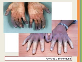 Raynaud’s phenomena