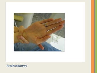 Arachnodactyly