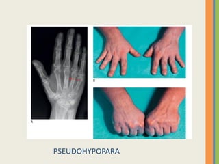 PSEUDOHYPOPARA