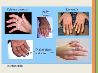Scleroderma