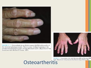 Osteoartheritis