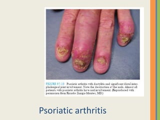 Psoriatic arthritis