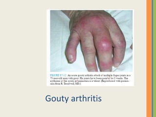 Gouty arthritis