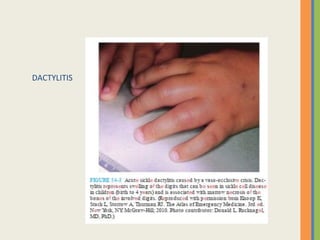 DACTYLITIS