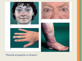 Thyroid acropachy in Grave’s