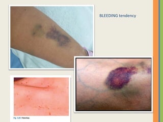 BLEEDING tendency