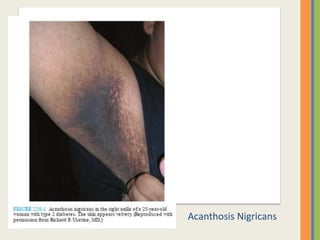 Acanthosis Nigricans