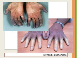 Raynaud’s phenomena