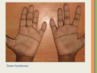 Down Syndrome