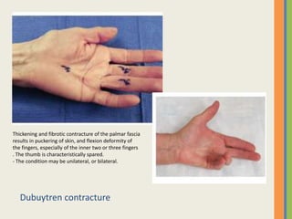 Dubuytren contracture
Thickening and fibrotic contracture of the palmar fascia
results in puckering of skin, and flexion deformity of
the fingers, especially of the inner two or three fingers
. The thumb is characteristically spared.
- The condition may be unilateral, or bilateral.