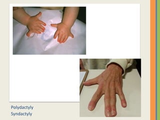 Polydactyly
Syndactyly
 
