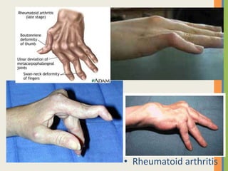Look
• Rheumatoid arthritis