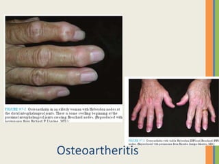 Osteoartheritis