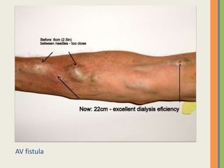 AV fistula
 