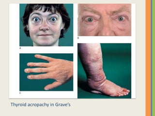 Thyroid acropachy in Grave’s