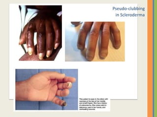 Pseudo-clubbing
in Scleroderma
