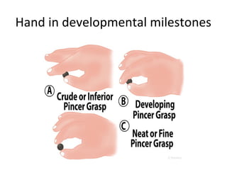 Hand a clue to pediatric diagnosis | PPT