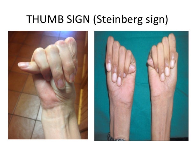 Hand A Clue To Pediatric Diagnosis