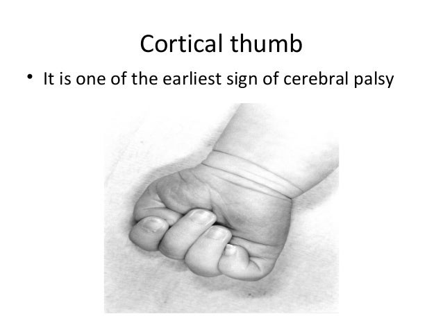 Hand A Clue To Pediatric Diagnosis