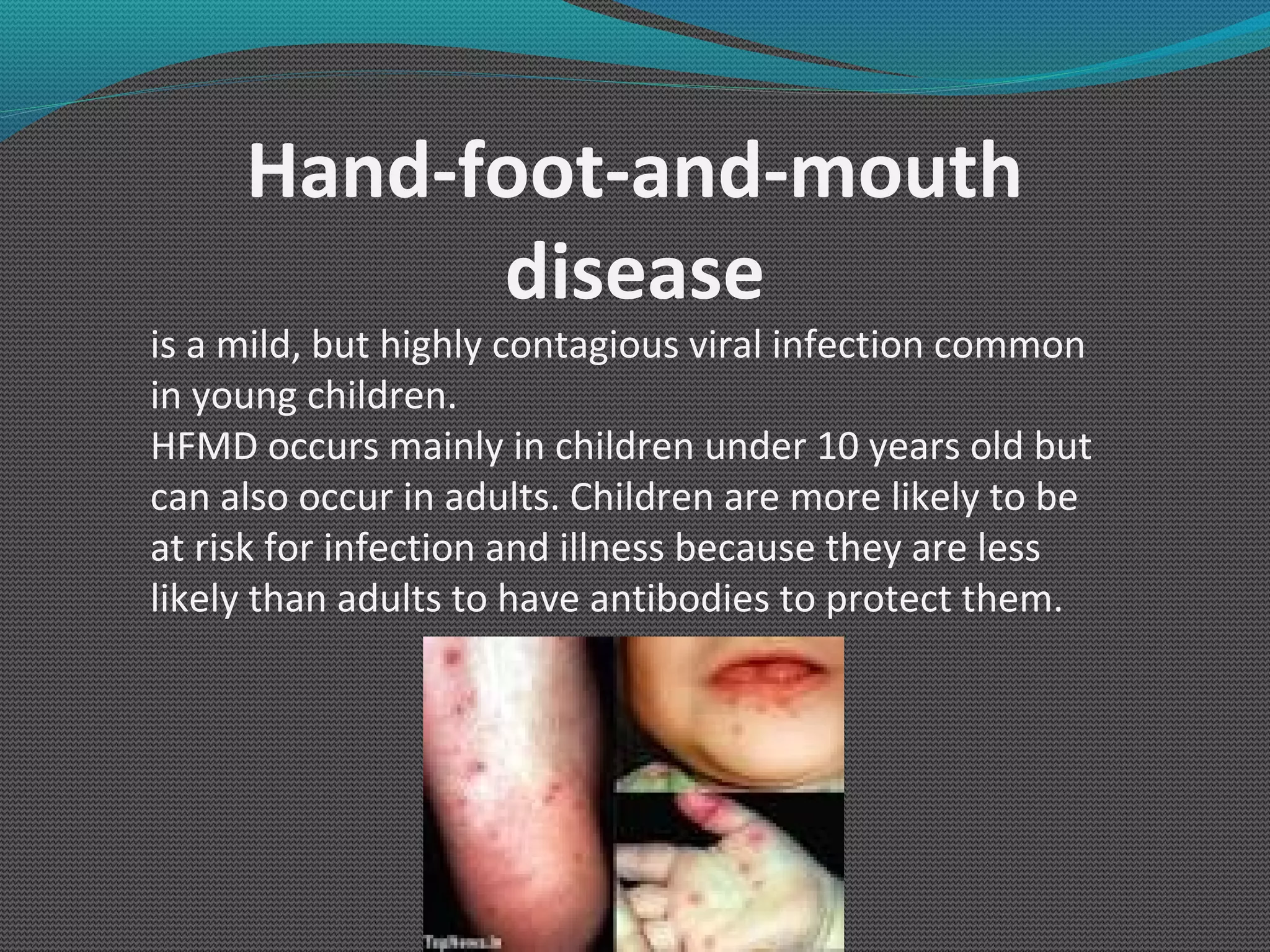 Hand Foot and Mouth Disease (HFMD) RIS Clinic