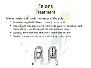 Felons
                           Treatment
Palmar incisions through the center of the pulp
    Avoid crossing the DIP flexion crease (contracture)
    Blade should only penetrate the dermis to avoid n/v structures and
     then a clamp is used to spread the subcutaneous tissue
    typically, drain over area of maximal tenderness or sinus
    Disadv:: scar over tactile surface, risk injury to dig. nerve
 