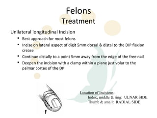 Felons
                            Treatment
Unilateral longitudinal Incision
    Best approach for most felons
    Incise on lateral aspect of digit 5mm dorsal & distal to the DIP flexion
     crease
    Continue distally to a point 5mm away from the edge of the free nail
    Deepen the incision with a clamp within a plane just volar to the
     palmar cortex of the DP




                                       Location of Incisions:
                                           Index, middle & ring: ULNAR SIDE
                                           Thumb & small: RADIAL SIDE
 