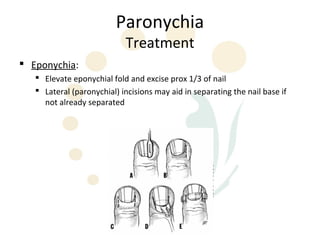 Paronychia
                            Treatment
 Eponychia:
    Elevate eponychial fold and excise prox 1/3 of nail
    Lateral (paronychial) incisions may aid in separating the nail base if
     not already separated
 