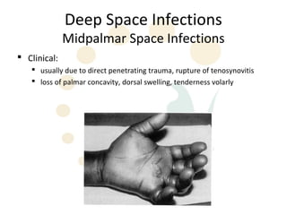 Deep Space Infections
              Midpalmar Space Infections
 Clinical:
    usually due to direct penetrating trauma, rupture of tenosynovitis
    loss of palmar concavity, dorsal swelling, tenderness volarly
 