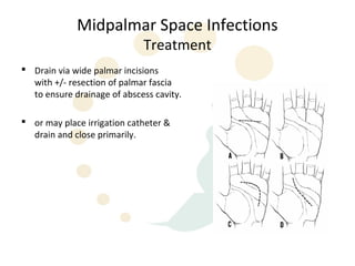 Midpalmar Space Infections
                             Treatment
 Drain via wide palmar incisions
  with +/- resection of palmar fascia
  to ensure drainage of abscess cavity.

 or may place irrigation catheter &
  drain and close primarily.
 