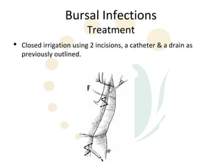 Bursal Infections
                         Treatment
 Closed irrigation using 2 incisions, a catheter & a drain as
  previously outlined.
 