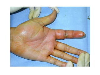 Hand infections