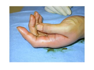 Hand infections