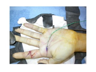 Hand infections