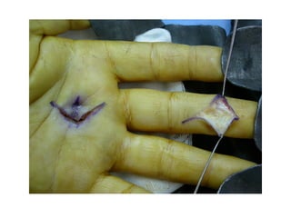 Hand infections