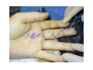 Hand infections