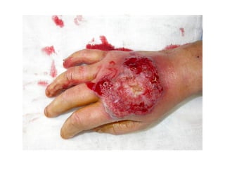 Hand infections