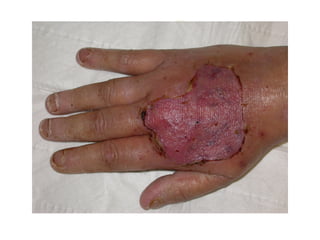 Hand infections