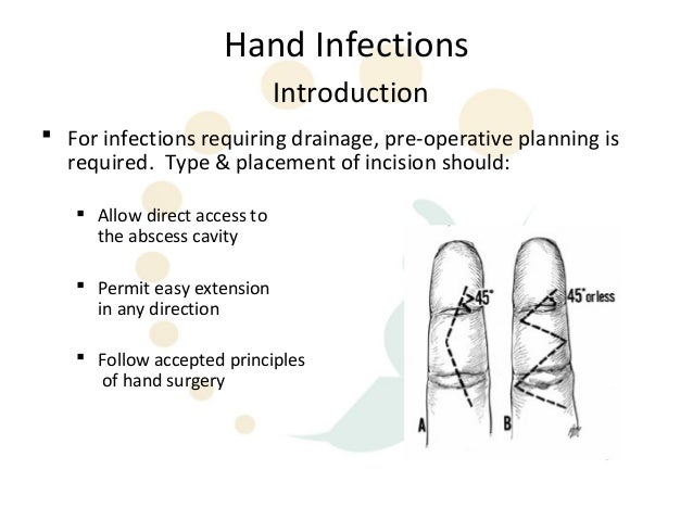 Hand Infection Incision