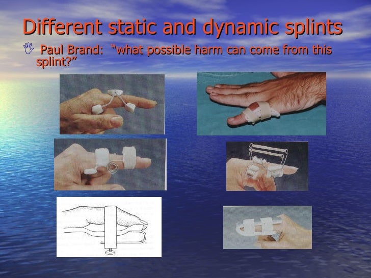 What is a serial static splint thegreenshara